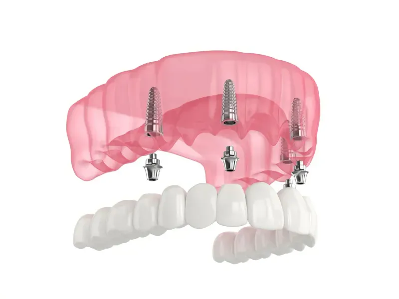 Pink dental implant model showing multiple titanium posts and prosthetic teeth components.