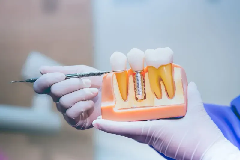Dental Implants in Oakland Park