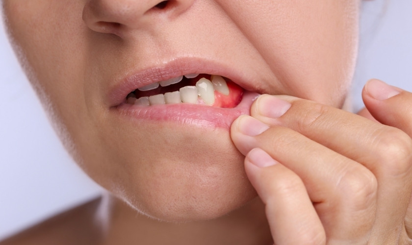 Reduce Gum Swelling
