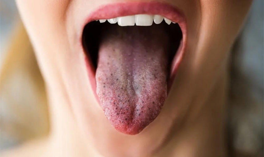 Remove Black Spots on the Tongue